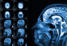 Neuroimaging Study Reveals Brain Difference in People With ADHD