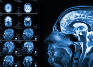 Neuroimaging Study Reveals Brain Difference in People With ADHD