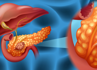 Pancreatic cancer survival linked to four genes