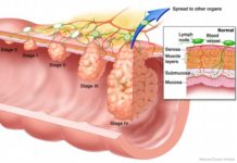 Study suggests colon cancer cells carry bacteria with them when they metastasize