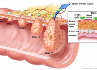 Study suggests colon cancer cells carry bacteria with them when they metastasize