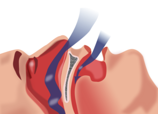 Synthetic cannabinoid reduces sleep apnea