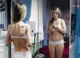 Obese and Anorexic Women Have Low Levels of Neurosteroid