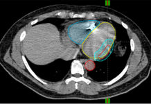 Deadly heart rhythm halted by noninvasive radiation therapy