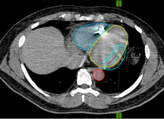 Deadly heart rhythm halted by noninvasive radiation therapy