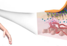 Pain-free skin patch responds to sugar levels for management of type 2 diabetes
