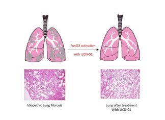 Pulmonary fibrosis caused by single transcription factor