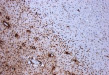 Researchers find potential path to repair multiple sclerosis-damaged nerves