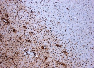 Researchers find potential path to repair multiple sclerosis-damaged nerves