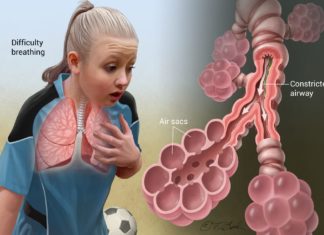 Study identifies new loci associated with asthma enriched in epigenetic marks