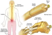 An innovative PET tracer can measure damage from multiple sclerosis in mouse models