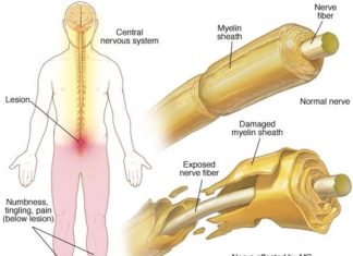 An innovative PET tracer can measure damage from multiple sclerosis in mouse models