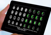 Brain-scan guided emergency stroke treatment can save more lives