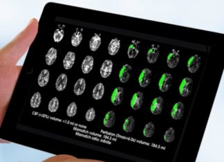 Brain-scan guided emergency stroke treatment can save more lives