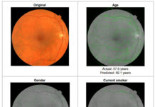 Eyes as a portal to cardiovascular risk factors