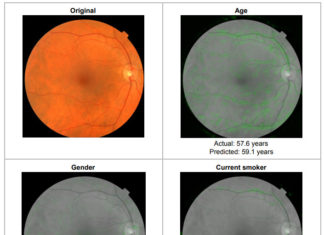 Eyes as a portal to cardiovascular risk factors