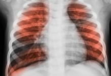 Glucose in the airways could increase infections in lung disease patients
