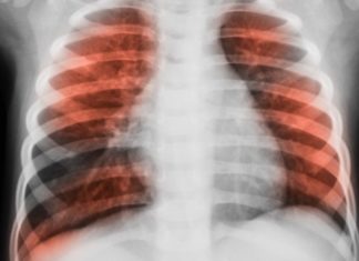Glucose in the airways could increase infections in lung disease patients