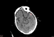 MedyMatch tech for pinpointing brain bleeds gets FDA nod for quick approval