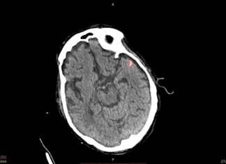 MedyMatch tech for pinpointing brain bleeds gets FDA nod for quick approval