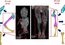 Monitoring fetal movements helps detect musculoskeletal malformations