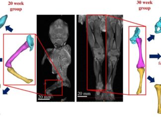Monitoring fetal movements helps detect musculoskeletal malformations
