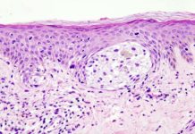 Rare melanoma type highly responsive to immunotherapy
