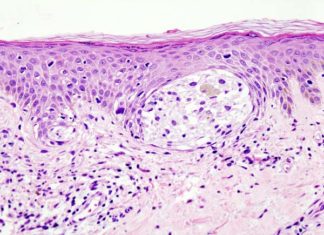 Rare melanoma type highly responsive to immunotherapy