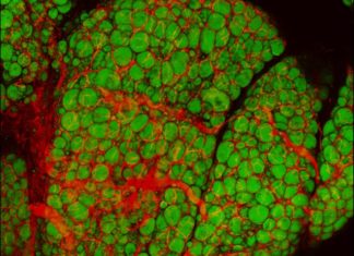 Scarring molecule in fat tissue links obesity with distressed fat