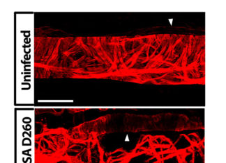 Study reveals how MRSA infection compromises lymphatic function
