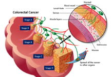 The sugar-attaching enzyme that defines colon cancer