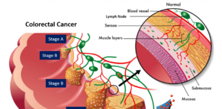 The sugar-attaching enzyme that defines colon cancer