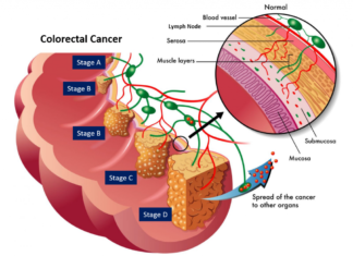 The sugar-attaching enzyme that defines colon cancer