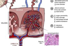 Zika virus damages placenta, which may explain malformed babies