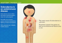 New study finds hope in understanding and better treating scleroderma