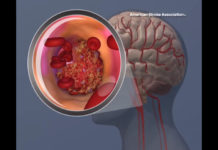 A hole in the heart increases post-surgical risk of stroke