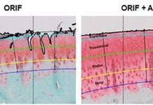 Acute treatment suppresses posttraumatic arthritis in ankle injury