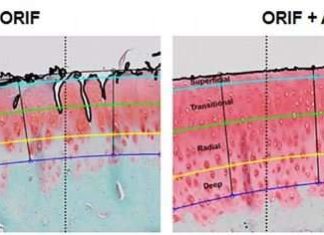 Acute treatment suppresses posttraumatic arthritis in ankle injury