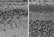 Antioxidant therapy prevents devastating vision loss when added to standard-of-care on rare birth defect