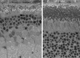 Antioxidant therapy prevents devastating vision loss when added to standard-of-care on rare birth defect