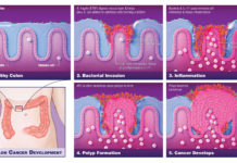 Bacteria play critical role in driving colon cancers