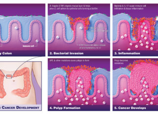 Bacteria play critical role in driving colon cancers