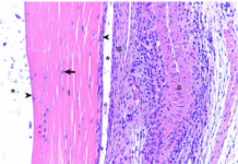 Cascading inflammation associated with Lyme arthritis linked to overactive immune response