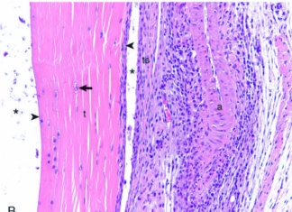 Cascading inflammation associated with Lyme arthritis linked to overactive immune response