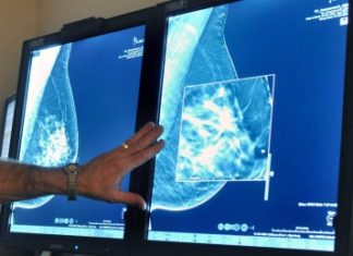 Doctors warn of heart risk from some breast cancer therapies