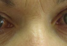 Glaucoma study finds brain fights to preserve vision