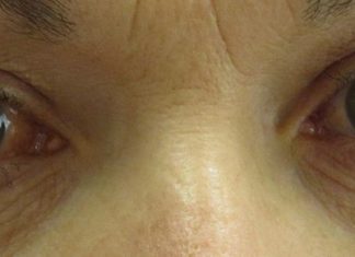 Glaucoma study finds brain fights to preserve vision