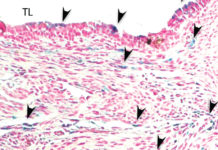 Iron triggers dangerous infection in lung transplant patients, study finds