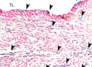 Iron triggers dangerous infection in lung transplant patients, study finds