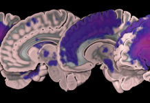 MRI Stroke Data Set Released
